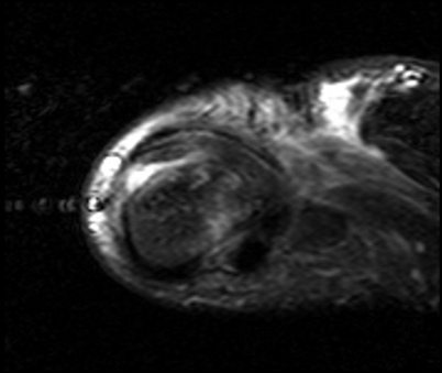stener thumb mriStener lesion diagram